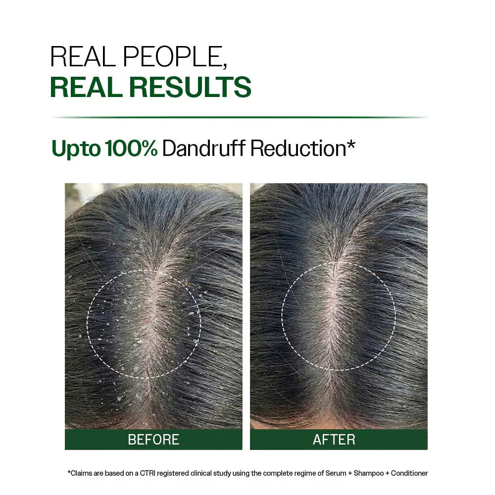 Anti Dandruff Shampoo with Salicylic Acid, Piroctone Olamine &amp; Biotin - 250ml - product image 8